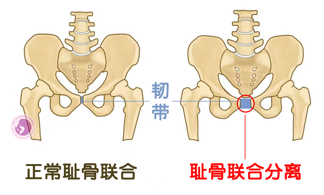 耻骨联合图片.png